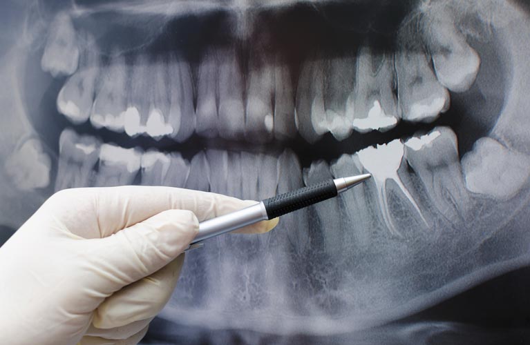 Endodontics | Sunninghill Dental