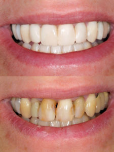 Before and after Smile design dental procedure photos . Selective soft focus.