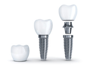 Tooth implant disassembled (done in 3d, isolated)