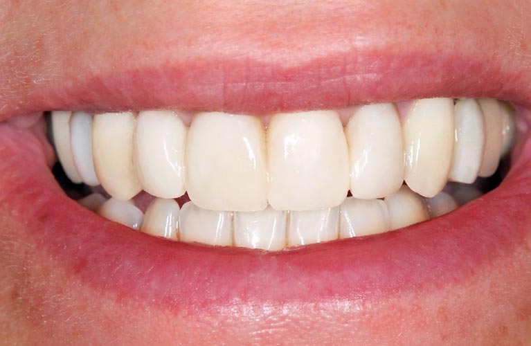 veneers Sunninghill Dental