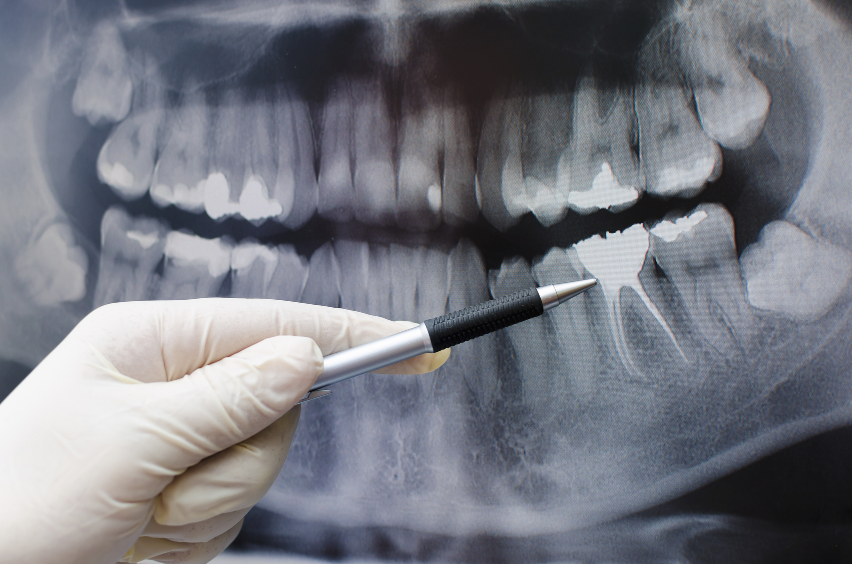 dentist-showing-something-on-dental-x-ray-image-sunninghill-dental